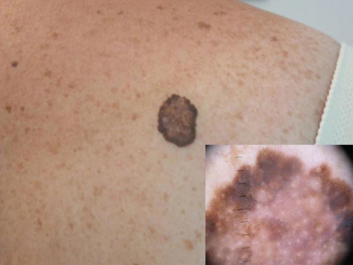 A FOST DESCOPERIT UN MECANISM CARE SĂ ÎMPIEDICE RĂSPÂNDIREA MELANOMULUI