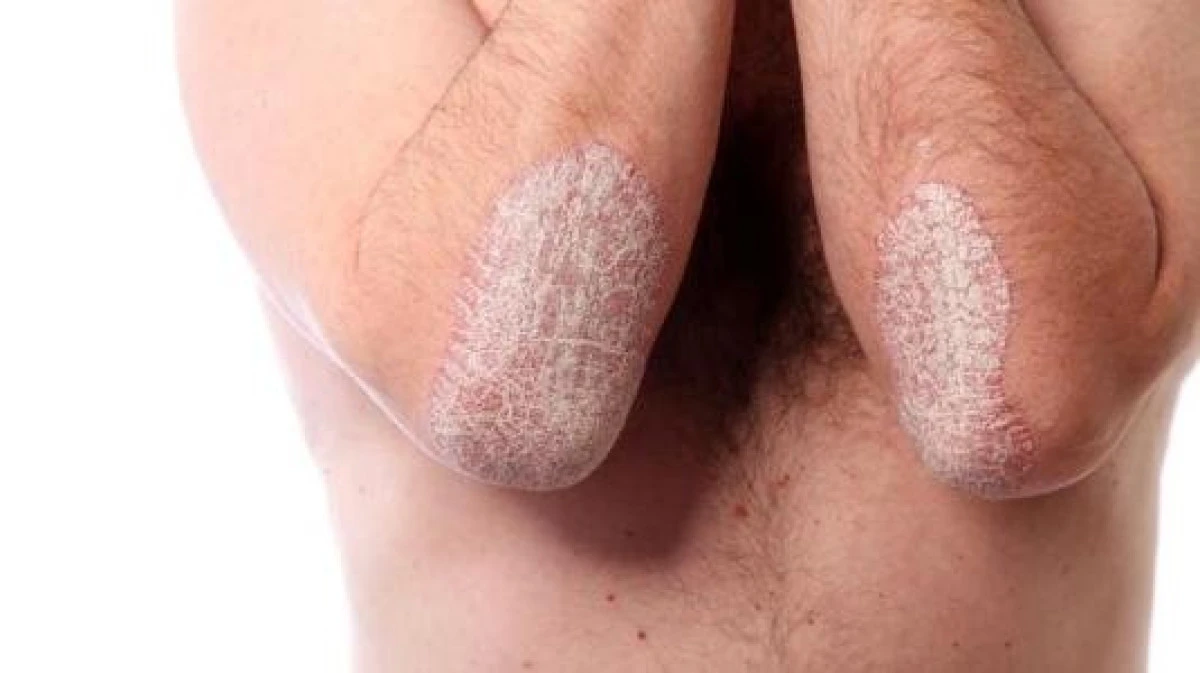 Afecțiunile cu care se poate asocia psoriazisul