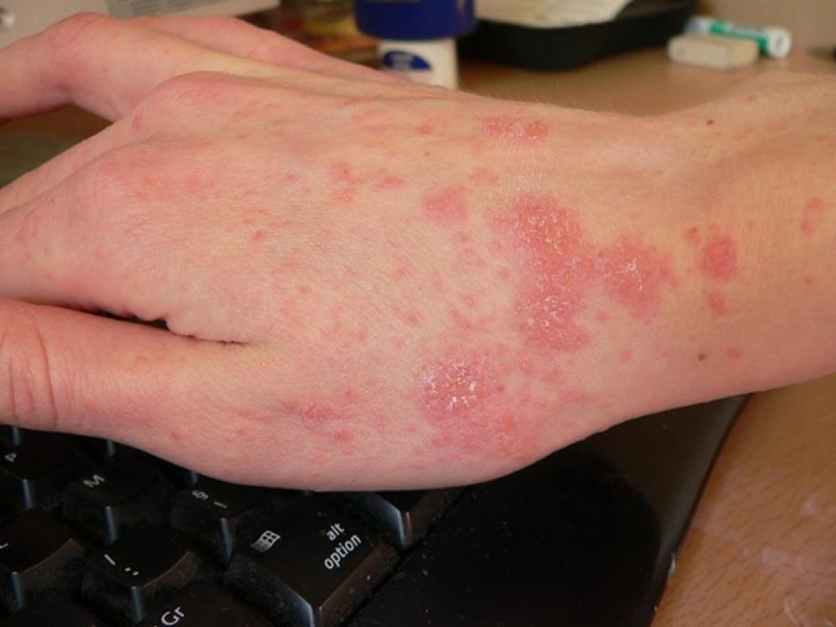 Alertă epidemiologică! Caz de râie confirmat într-un liceu din Arad
