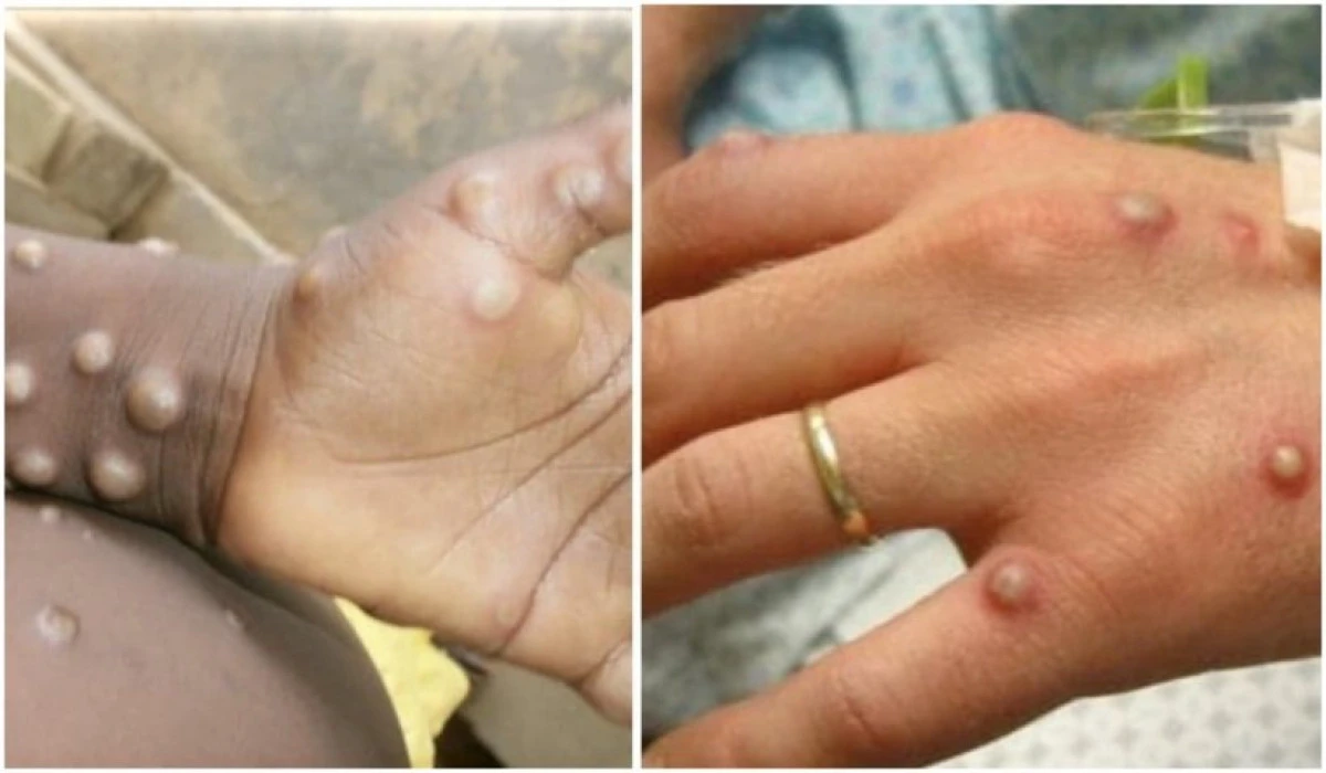 Alte patru persoane din Marea Britanie au fost diagnosticate cu variola maimuțelor