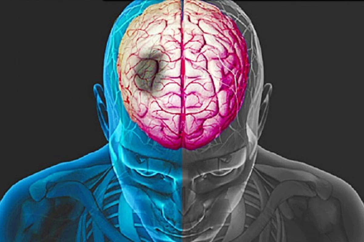 Care sunt semnele unui accident vascular