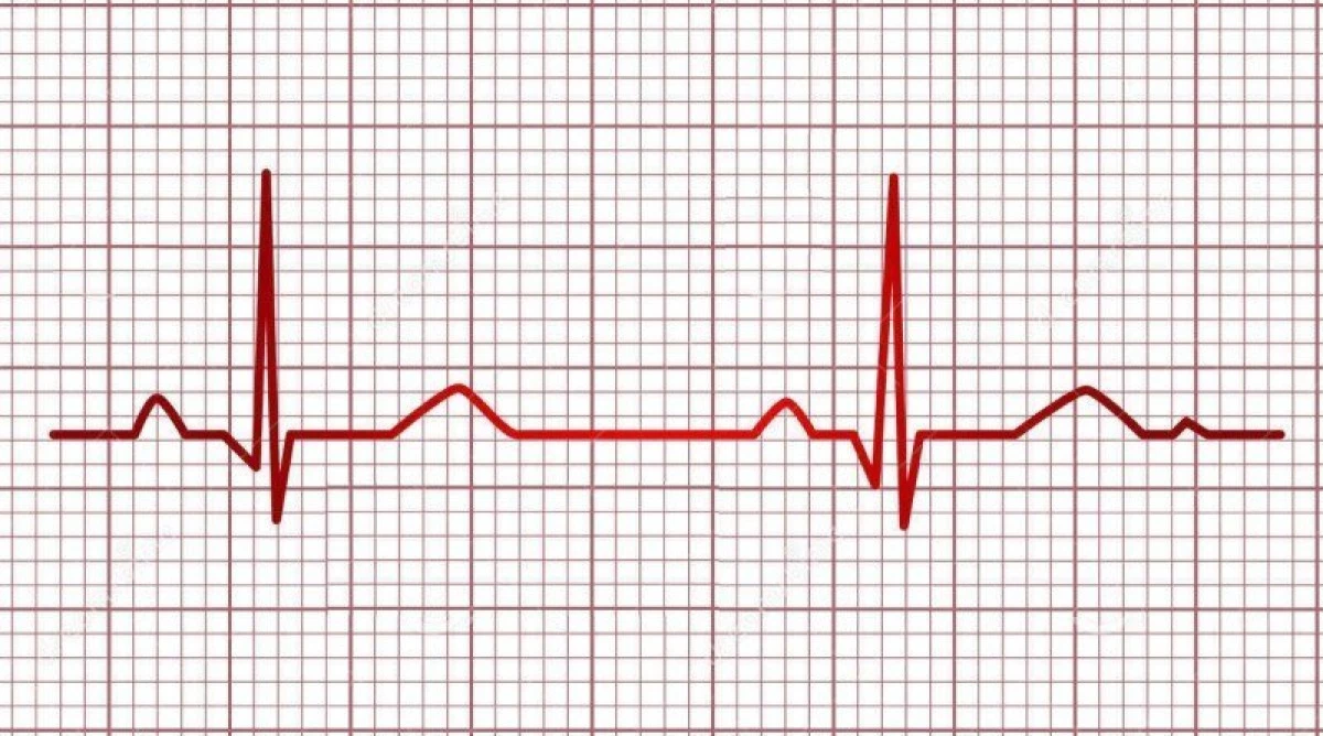 Ce este și când trebuie făcută electrocardiograma