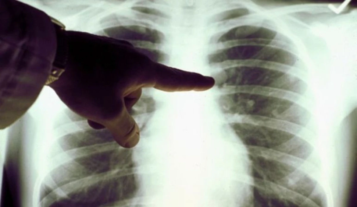 Ce trebuie să știm despre cancerul pulmonar