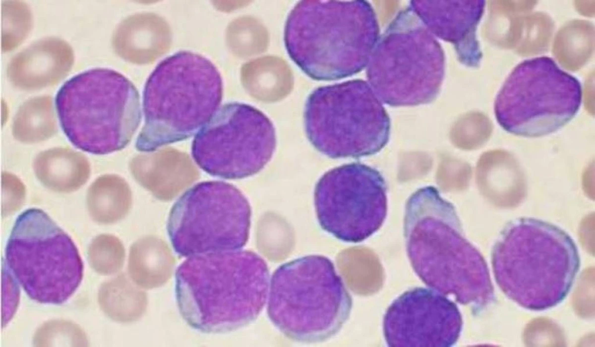 CERCETATORII AU DESCOPERIT ACCIDENTAL CUM POATE FI VINDECATA LEUCEMIA