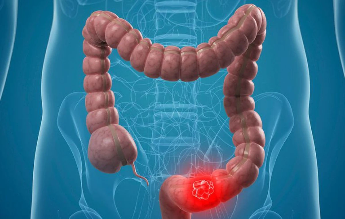 Consumul regulat de pește reduce riscul de cancer colorectal