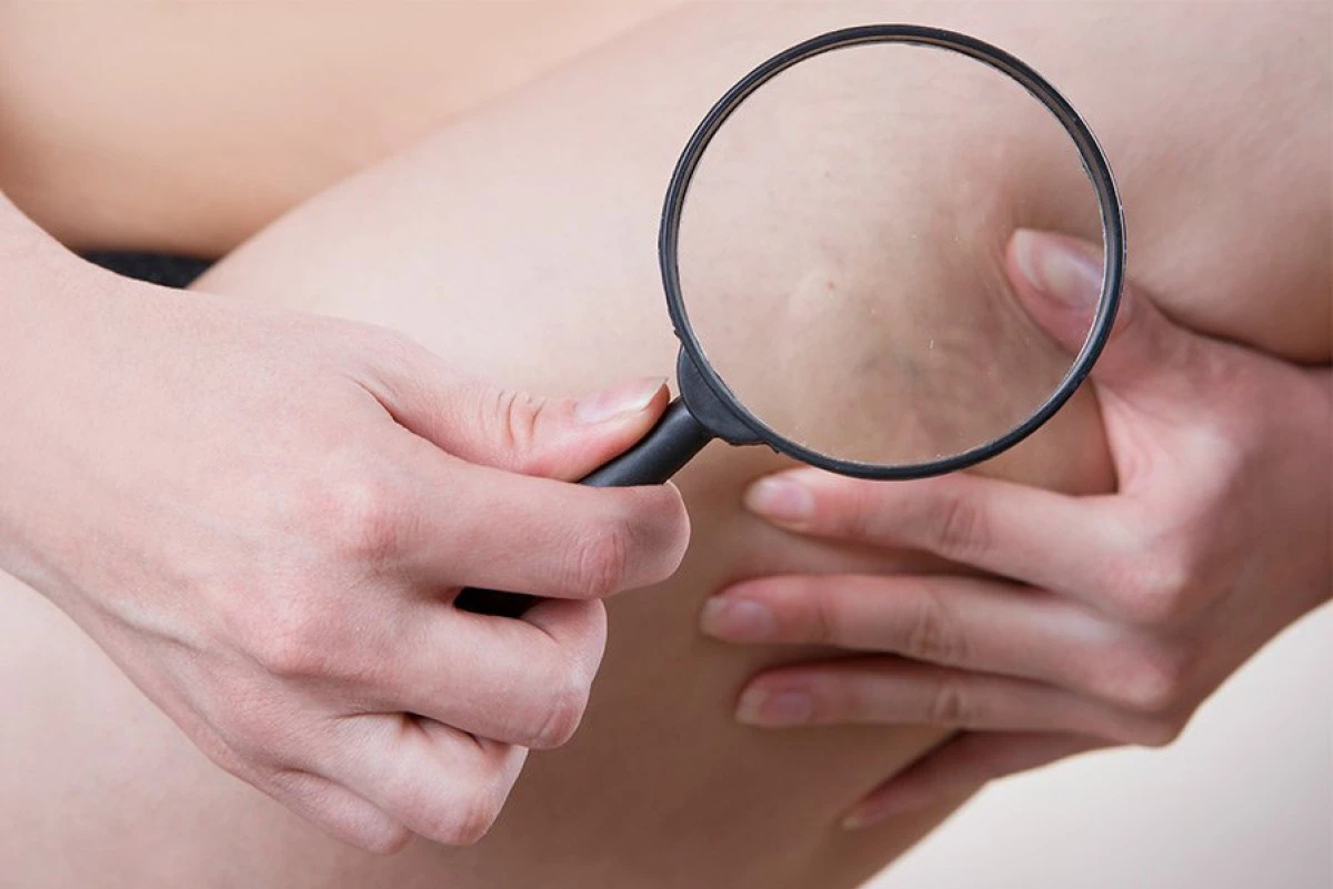 Cum poți preveni apariția varicelor