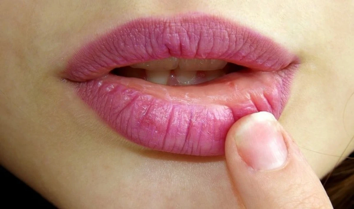 Cum poți scăpa de herpes în doar câteva ore
