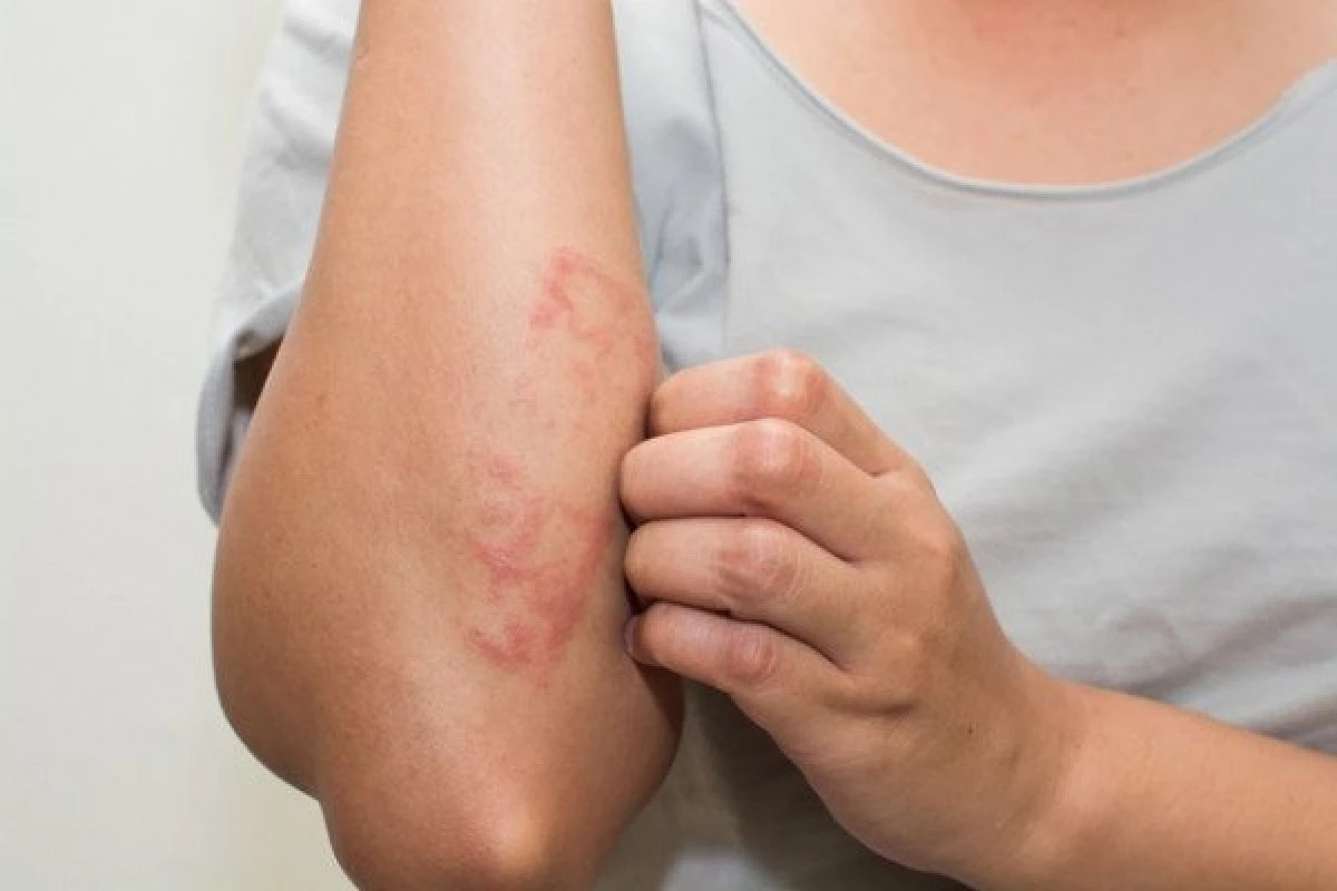 Cum putem trata psoriazisul în mod natural