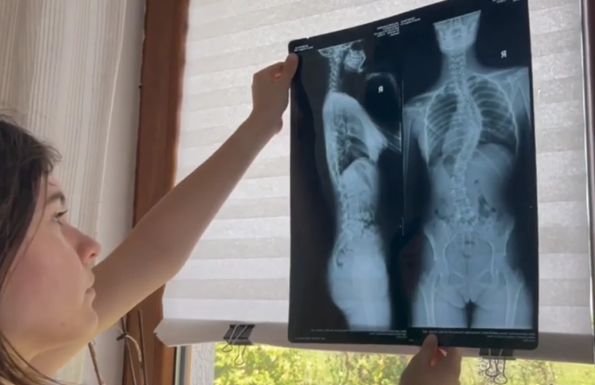 Diana are 12 ani și luptă cu o deformare severă a coloanei vertebrale