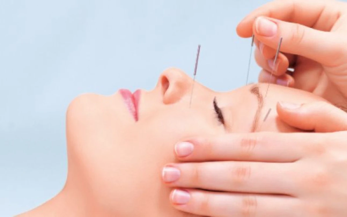 Durerile de cap și acupunctura
