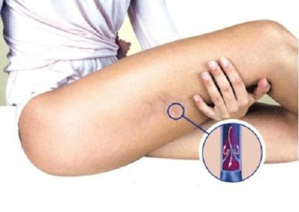 Factorii care duc la apariţia aterosclerozei