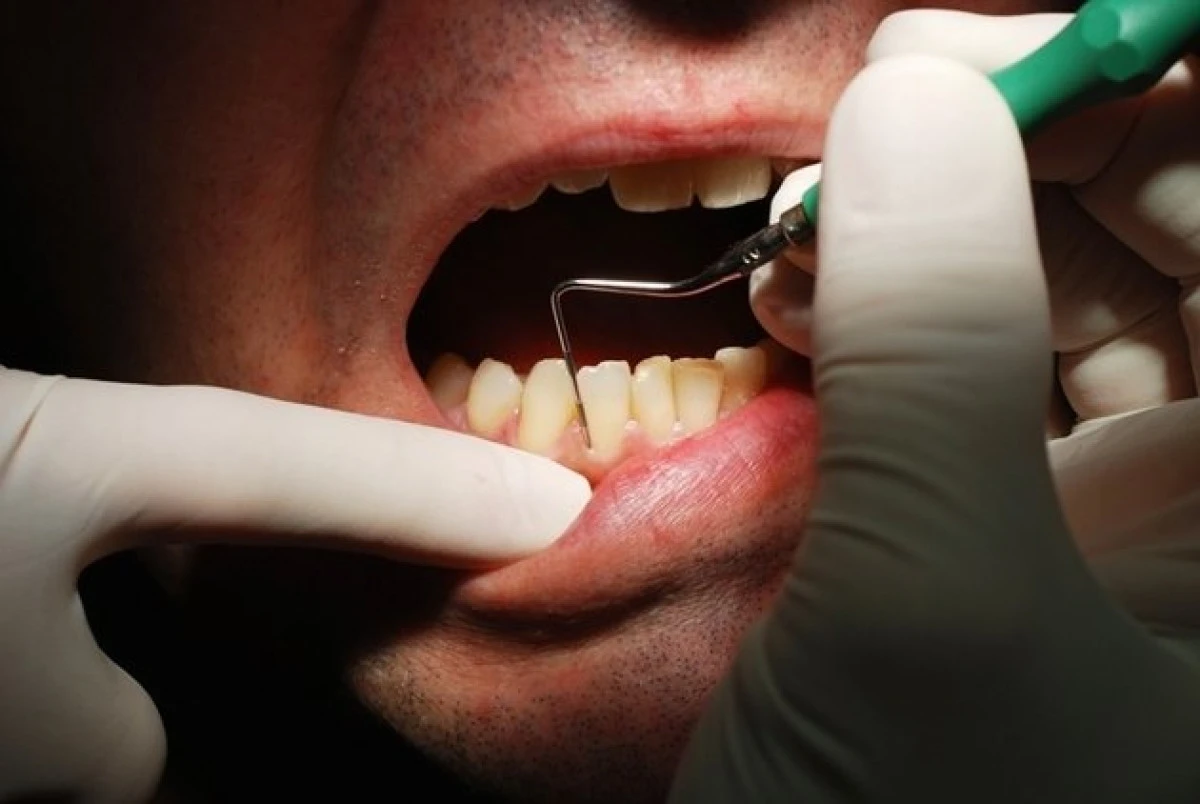 Legătura dintre igiena orală și cancerul la ficat