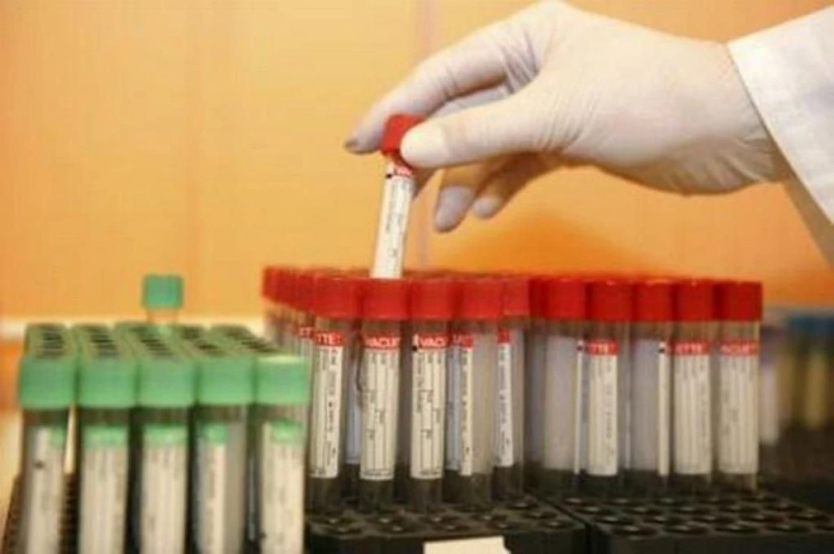 O NOUA TERAPIE ANTI-HIV, REALIZATA CU ANTICORPI NATURALI, OFERA REZULTATE PROMITATOARE
