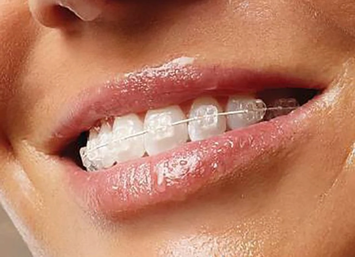 Până la ce vârstă se poate purta aparat dentar