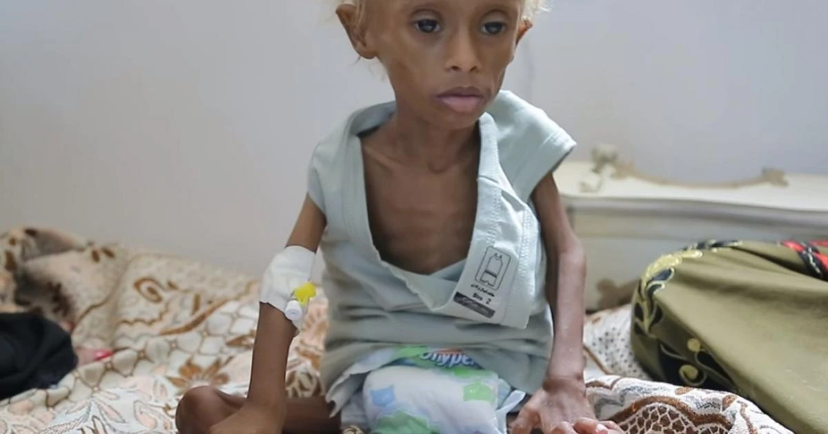 Peste 80.000 de copii au murit de malnutriție din cauza crizei din Yemen
