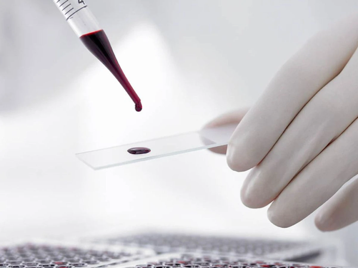 PREMIERĂ NAȚIONALĂ ÎN TRATAMENTUL PACIENȚILOR CU BOLI HEMATOLOGICE MALIGNE