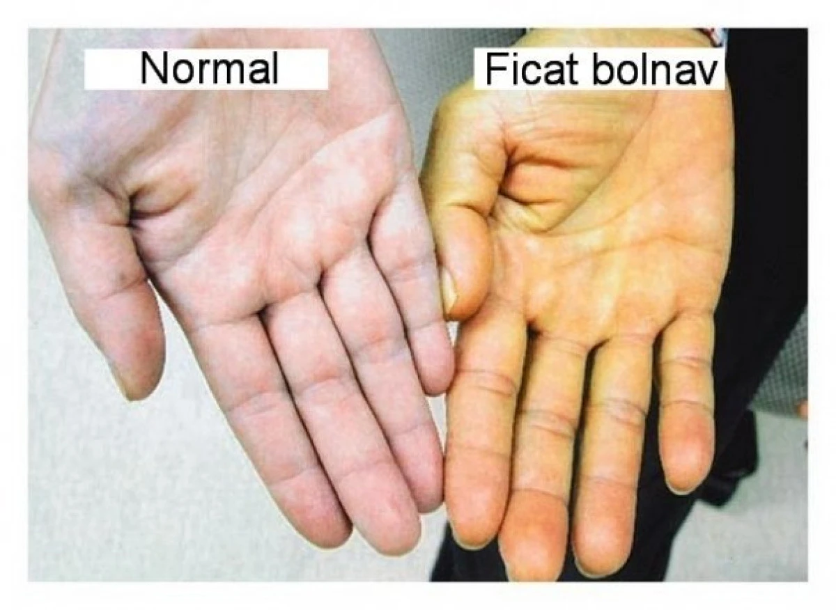 Primele semne care anunță un ficat bolnav