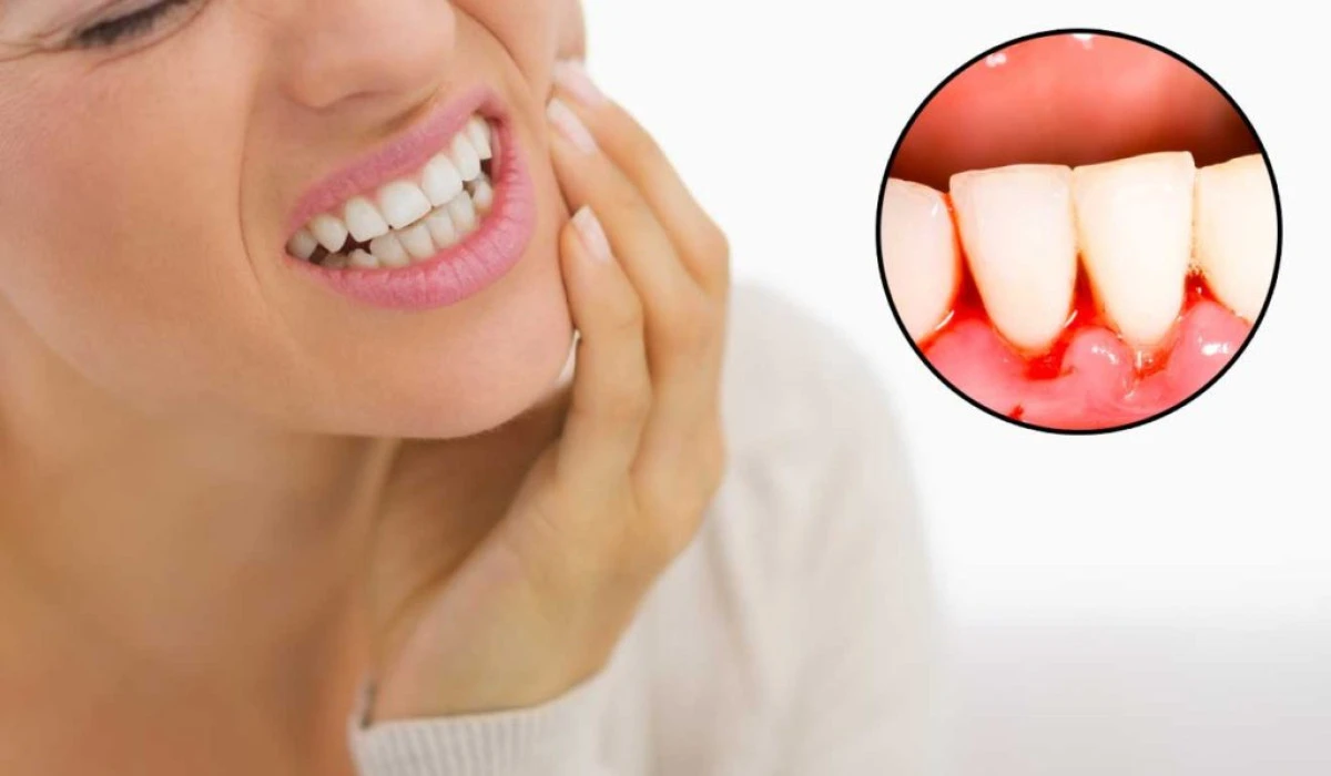 Remedii naturiste împotriva sângerărilor gingivale