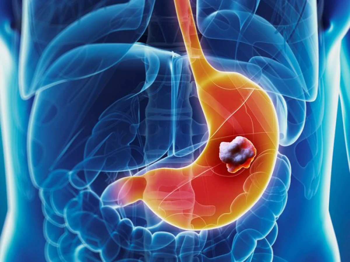 Semnele care te pot face să te gândesti la cancerul de stomac