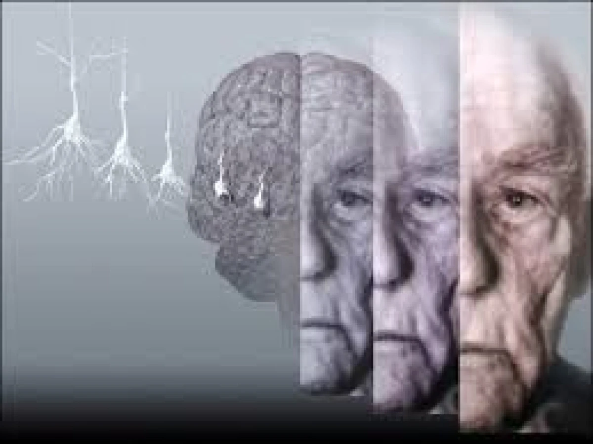SEMNELE CARE TRADEAZA APARITIA ALZHEIMERULUI