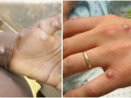 Alte patru persoane din Marea Britanie au fost diagnosticate cu variola maimuțelor