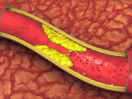 BAUTURA CE ELIMINA TOXINELE SI GRASIMEA DEPUSA PE PERETII VASELOR DE SANGE