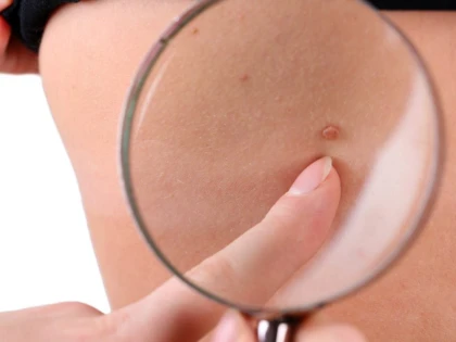 Cancerul de piele face tot mai multe victime în rândul bărbaților