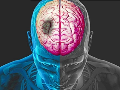 Care sunt semnele unui accident vascular