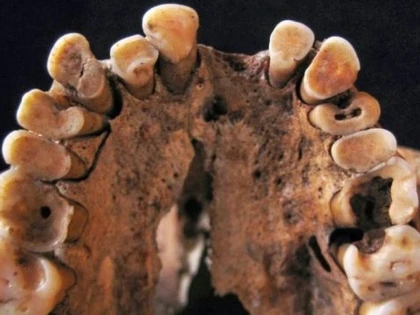 CAT DE VECHE ESTE DE FAPT STOMATOLOGIA: PRIMA DOVADA A INTERVENTIEI UNUI DENTIST