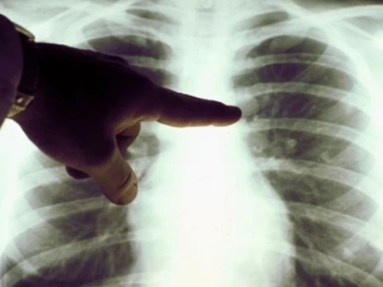 Ce trebuie să știm despre cancerul pulmonar