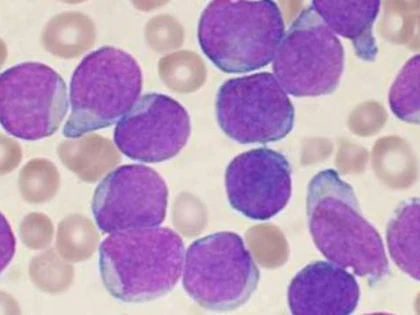 CERCETATORII AU DESCOPERIT ACCIDENTAL CUM POATE FI VINDECATA LEUCEMIA