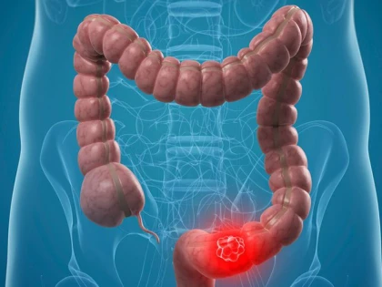 Consumul regulat de pește reduce riscul de cancer colorectal