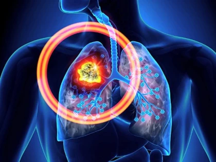 Cum putem preveni cazurile de cancer pulmonar