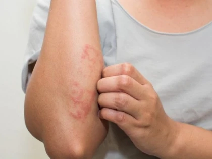 Cum putem trata psoriazisul în mod natural