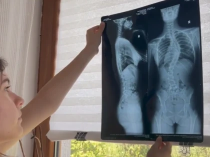 Diana are 12 ani și luptă cu o deformare severă a coloanei vertebrale