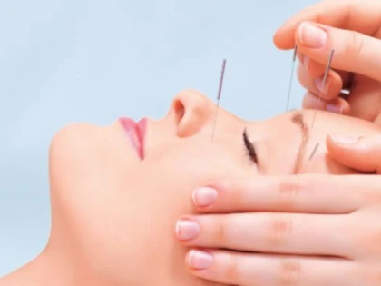 Durerile de cap și acupunctura
