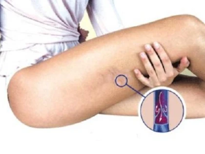 Factorii care duc la apariţia aterosclerozei