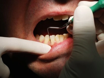Legătura dintre igiena orală și cancerul la ficat