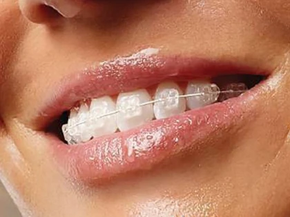 Până la ce vârstă se poate purta aparat dentar