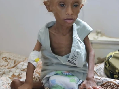 Peste 80.000 de copii au murit de malnutriție din cauza crizei din Yemen