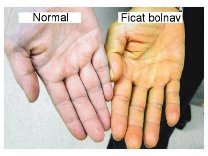 Primele semne care anunță un ficat bolnav