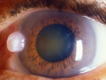 Primele simptome ale cataractei. De ce n-ar trebui să amâni vizita la medic