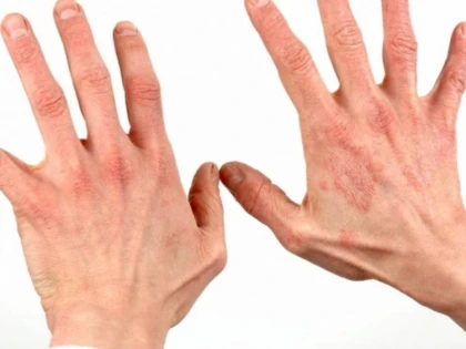 PSORIAZIS: CAUZE, TIPURI, SIMPTOME, TRATAMENT