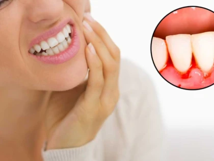 Remedii naturiste împotriva sângerărilor gingivale