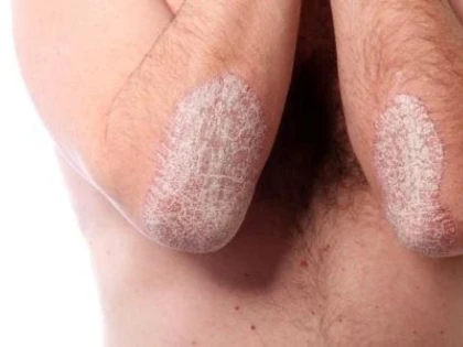 Remediul naturist pentru psoriazis despre care nu multă lume știe