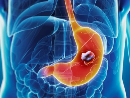 Semnele care te pot face să te gândesti la cancerul de stomac