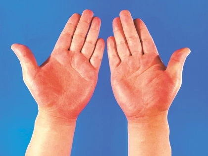 Vezi care sunt simptomele cirozei hepatice, boala care a ucis-o pe Ileana Ciuculete